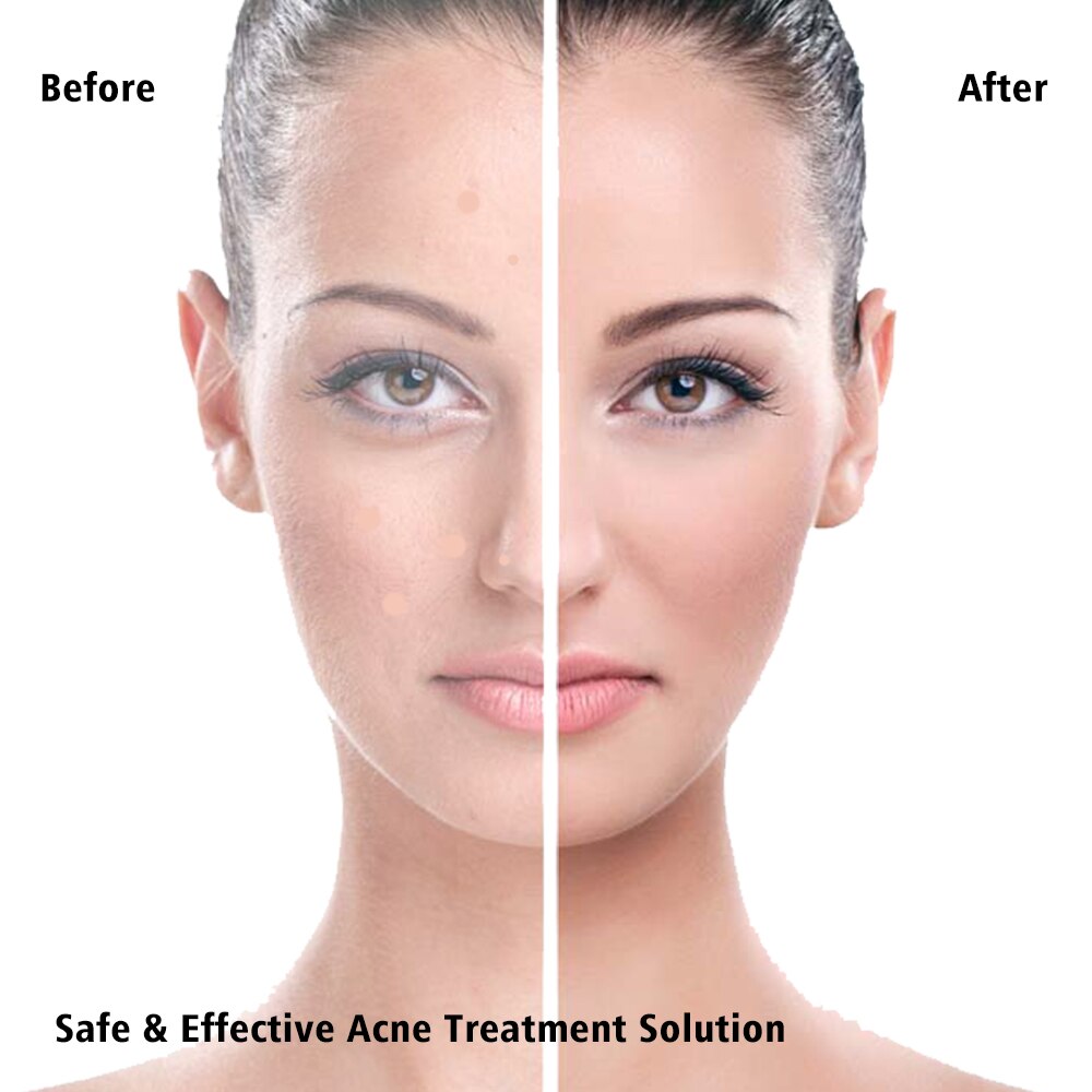 36 Patches Acne Pimple